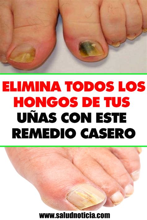 Elimina Todos Los Hongos De Tus Uñas Con Este Remedio Casero Remedios Caseros Hongos Casero