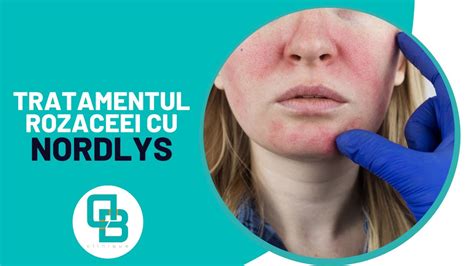 Tratamentul Rozaceei Cu Laserul Nordlys Dermabeauty Clinique Youtube