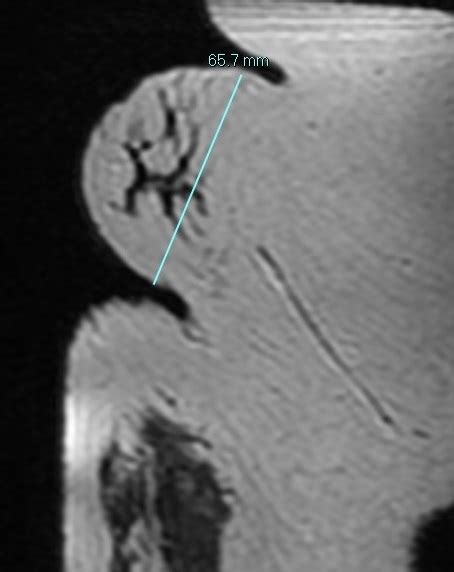 Ectopic Axillary Breast Tissue Image