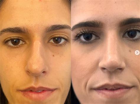 Rinoplastia De Nariz Bulbosa Icifacial