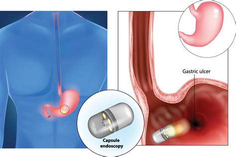 Capsule Endoscopy Advanced Gastroenterology
