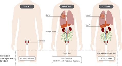 Advances In Diagnosis And Treatment Of Testicular Cancer The Bmj