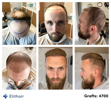 DHI Haartransplantation Alle Infos Zur DHI Methode Elithair