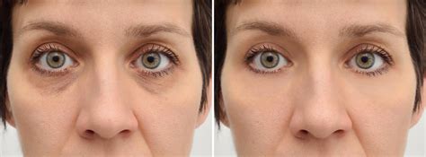 Blepharoplasty Complications Glasgold Group