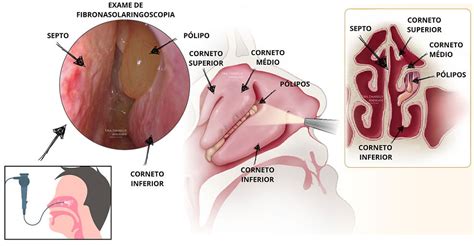 O Que É Um Pólipo Nasal - Pólipo Nasal: Causas, Sintomas e Tratamento
