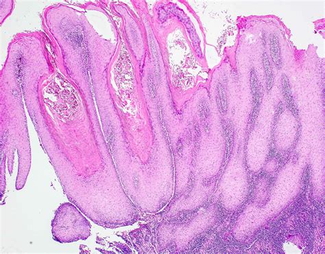 Proliferative Verrucous Leukoplakia Histology