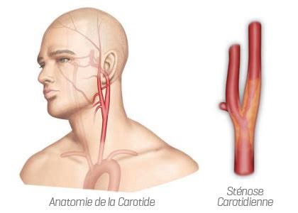 Docteur Pierre Franck Planchard Chirurgie Vasculaire