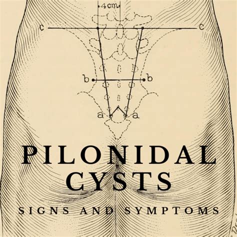 Diagram Of Pilonidal Cyst