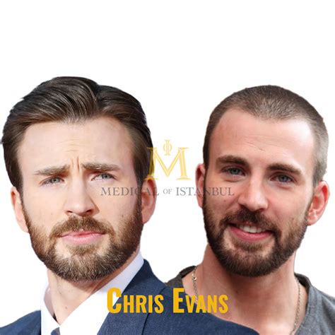 Chris Evans Hair Transplant A Journey of Transformation