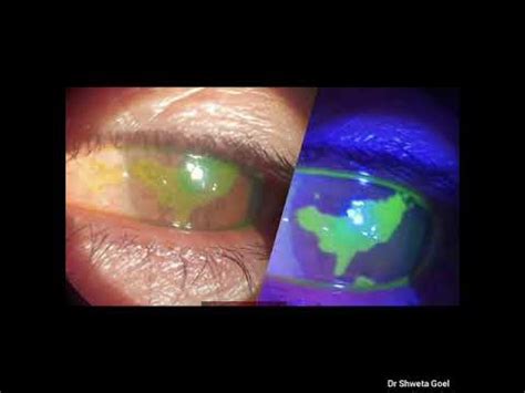 fluorescein stain test youtube