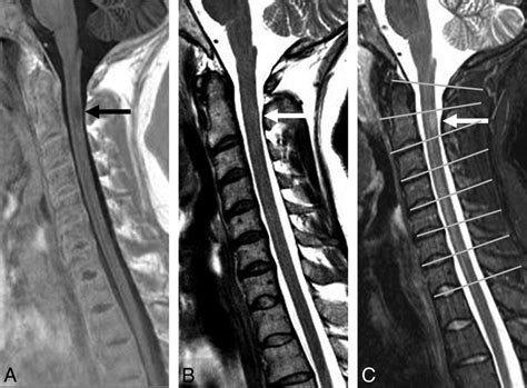 Sagittal Psir A Fse T B And Stir C Sequences In A Patient With