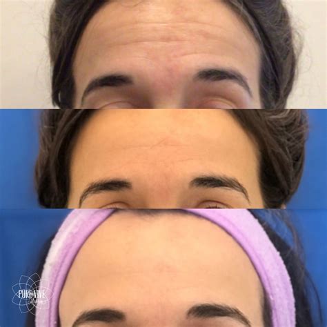 Look At These Amazing Microneedling Results Thanks To The SkinPen