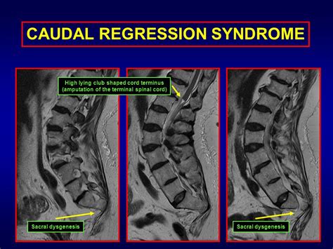 Caudal Regression Syndrome Mri