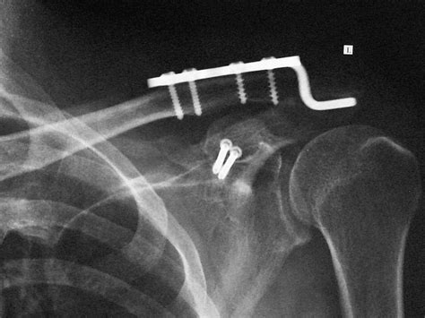 Treatment Of Coracoid Process Fractures Associated With Acromioclavicular Dislocation Using