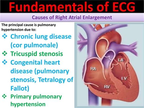 P wave abnormalities in ECG