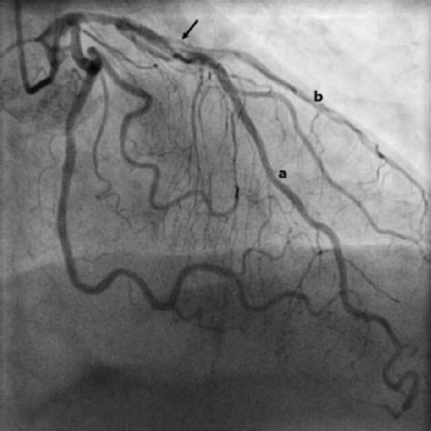 Preoperative Coronary Angiogram Showing A Severely Stenotic Left