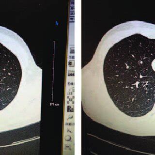 (A) Saccular bronchiectasis of the right middle lobe. (B) Reversal of ...