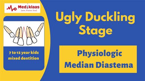 Ugly Duckling Stage L Mixed Dentition L Mediklaas Youtube