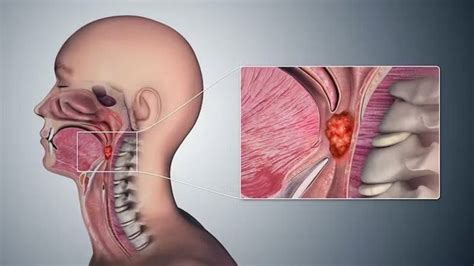 Cáncer de garganta por qué el sexo oral puede ser un factor de riesgo