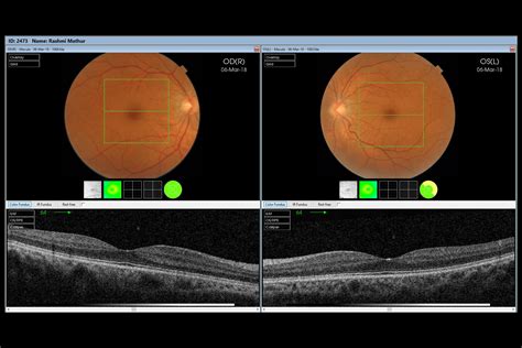 oct optical coherence tomography rmoptical