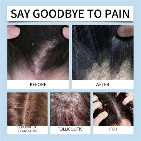 Seborrheic Dermatitis Cream, Psoriasis Cream, Scalp Relief for