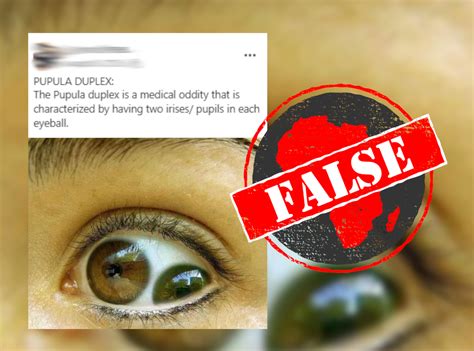 No evidence of ‘pupula duplex’ or ‘medical oddity’ causing two irises ...
