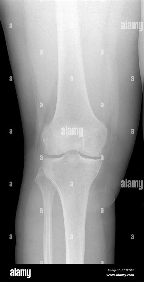 Imagen de rayos X de rodilla. Detección de osteoartritis radiográfica ...