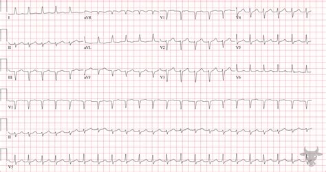 Atrioventricular Nodal Reentrant Tachycardia Ecg Stampede