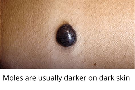 Skin Moles to Worry About – A Complete Guide With Skin Moles Pictures