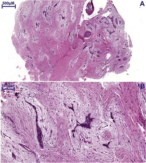 Desmoplastic Ameloblastoma A Systematic Review Of The Cases Reported