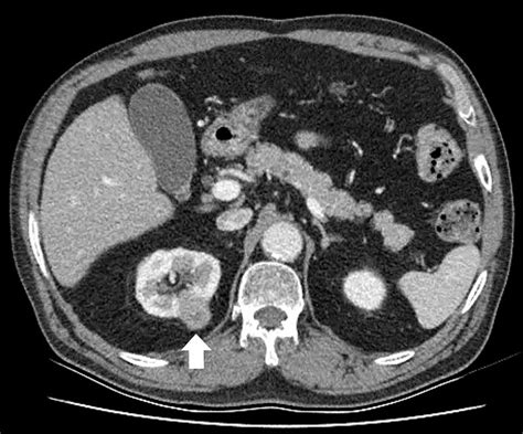 Renal Metastasis Of Small Cell Lung Cancer With Urothelial Carcinoma Of