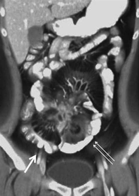 Computed Tomography Enterography Cte Of 26 Year Old Male With Active