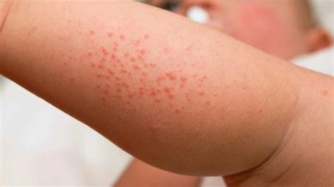 What Does A Strep Rash Look Like Torrinomedica