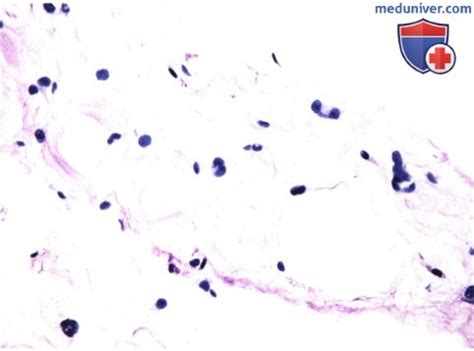 Липома глазницы: признаки, гистология, лечение, прогноз
