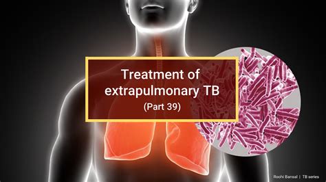 Treatment of extrapulmonary TB (Part 39) | by Roohi Bansal ...