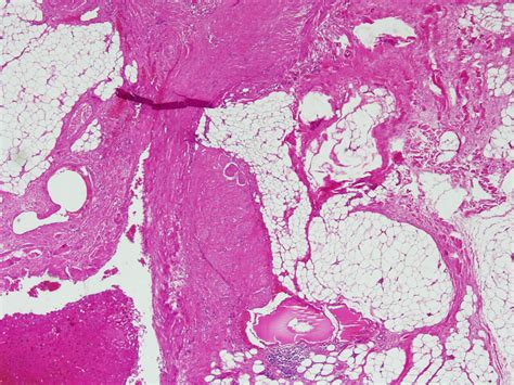 Malignant Mesothelioma Pathology Outlines