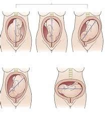 Intrapartum Flashcards Quizlet