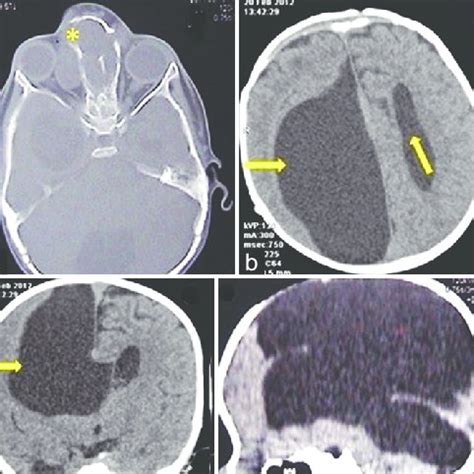 2-year-old female child with swelling at nasal bridge, (a) sagittal ...