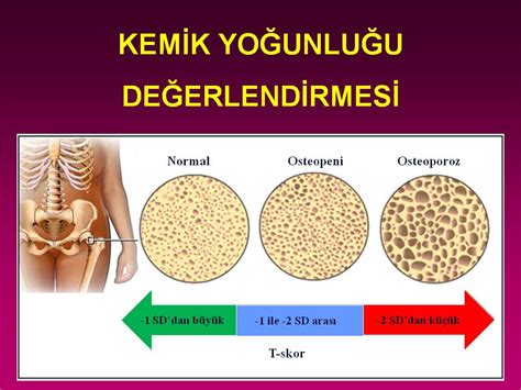 Osteoporoz Prof Dr Ba Ak Baksu