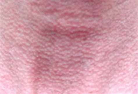 Lupus Rash – Pictures, Symptoms, Causes, Treatment | HubPages