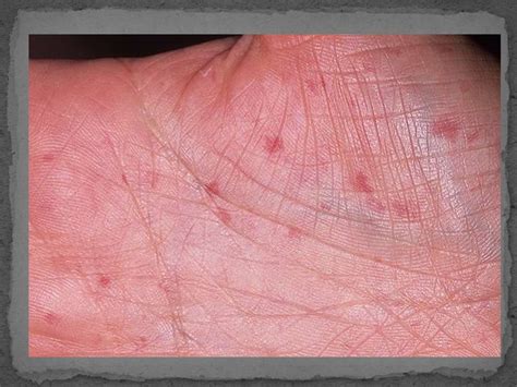 Склеродермия - презентация онлайн