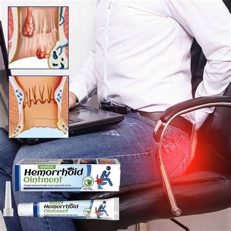 Ouhoe Hemorrhoids Ointment Relieve Pain Hemoroid Cream Anal Bleeding Swelling Anal Fissure