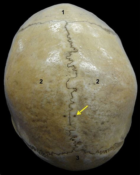 Parietal Foramina