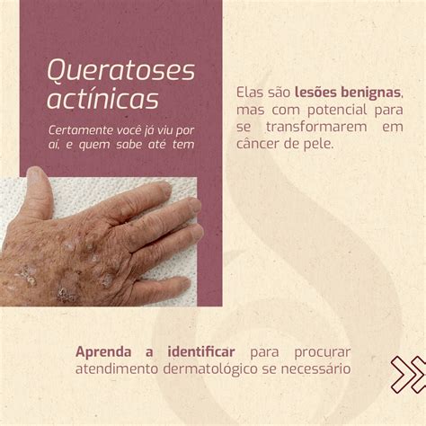 A Queratose Actínica é Um Tipo De Dra Joice Göebel
