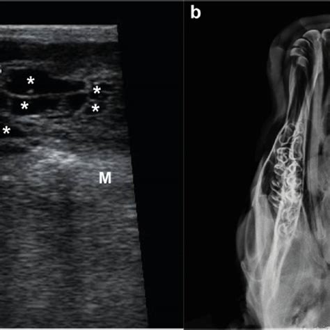 Imaging of the suborbital mass. (a) US image showing the three ...