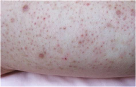 What are Crusty Patches on Skin? How to treat scaly spots on skin?