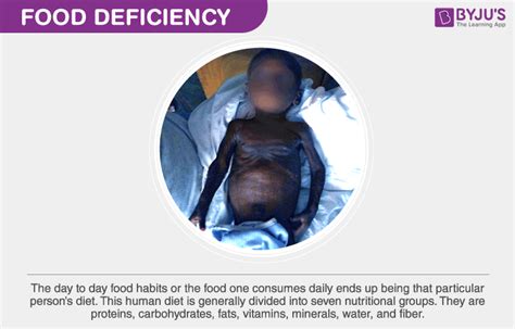 Food Deficiency List Of Nutrients Sources And Their Deficiencies