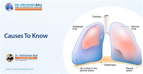 Respiratory Conditions That Lead To A Collapsed Lung