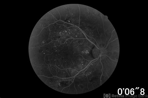 Diabetic Retinopathy Hard Exudates OD Early Phase - Retina Image Bank