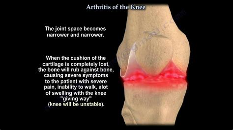 Knee arthritis symptoms and treatment - Everything You Need To Know ...